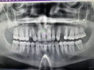 The best dental clinic in turkey | dental implants in turkey | All on 6 | All on 4 | Zirconium crowns | ALL ON X clinic